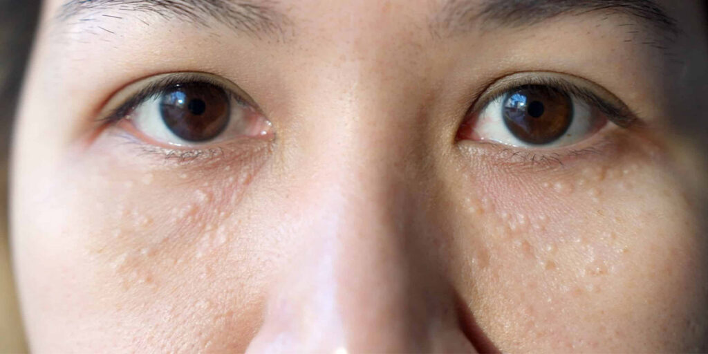 close-up of a face with syringoma