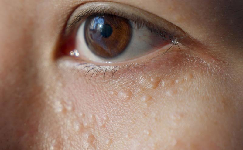 person with small white bumps on the face