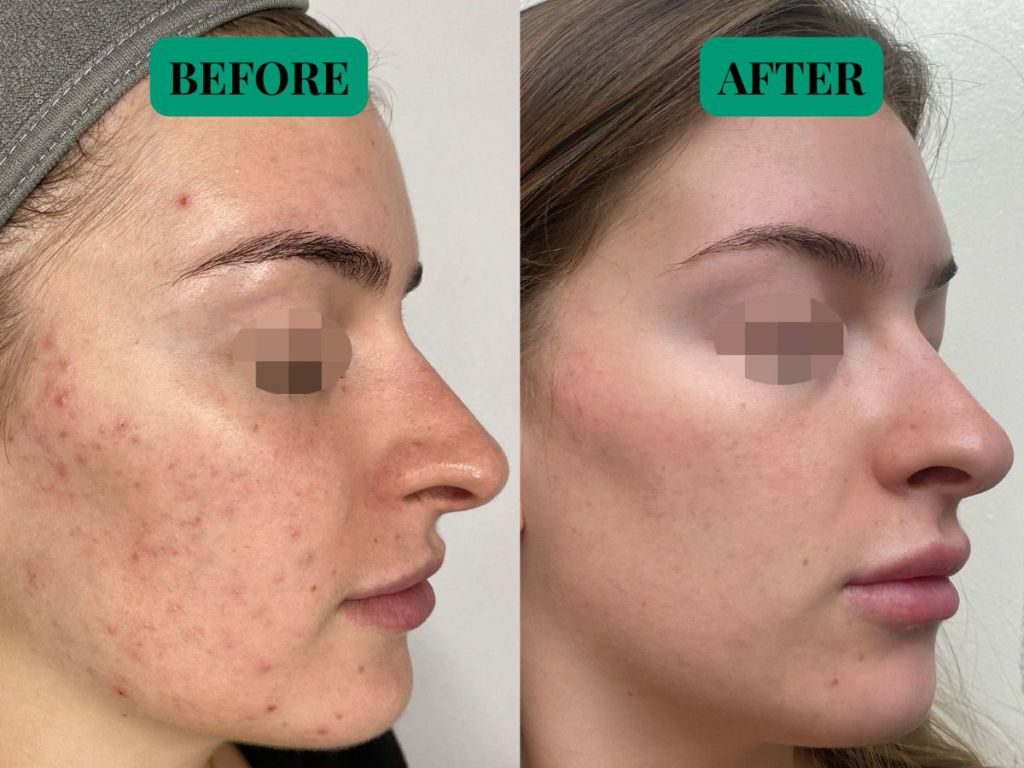 Before and After acne scars treatment with Alma Harmony